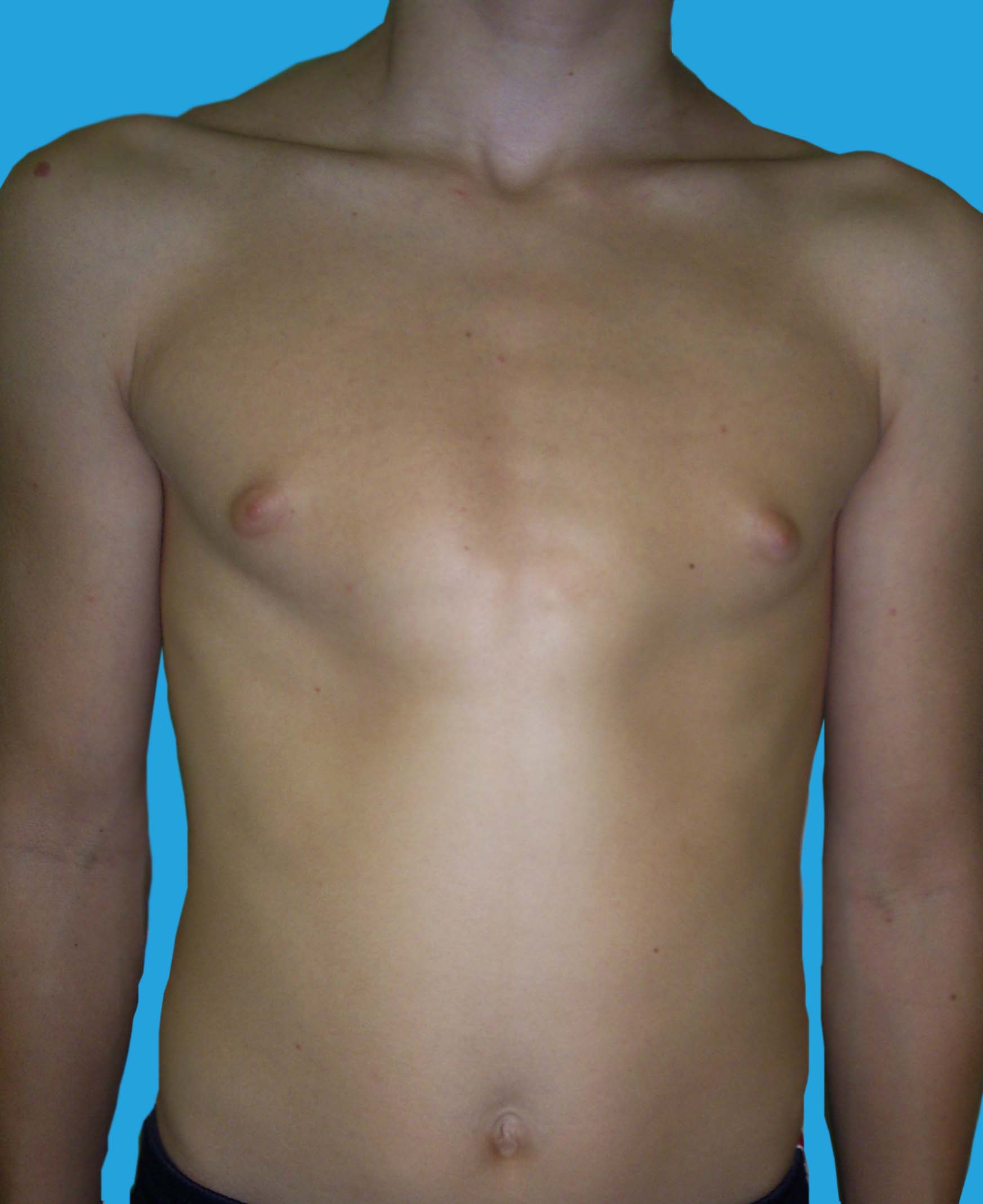 воронкообразная грудь у мужчин фото 57
