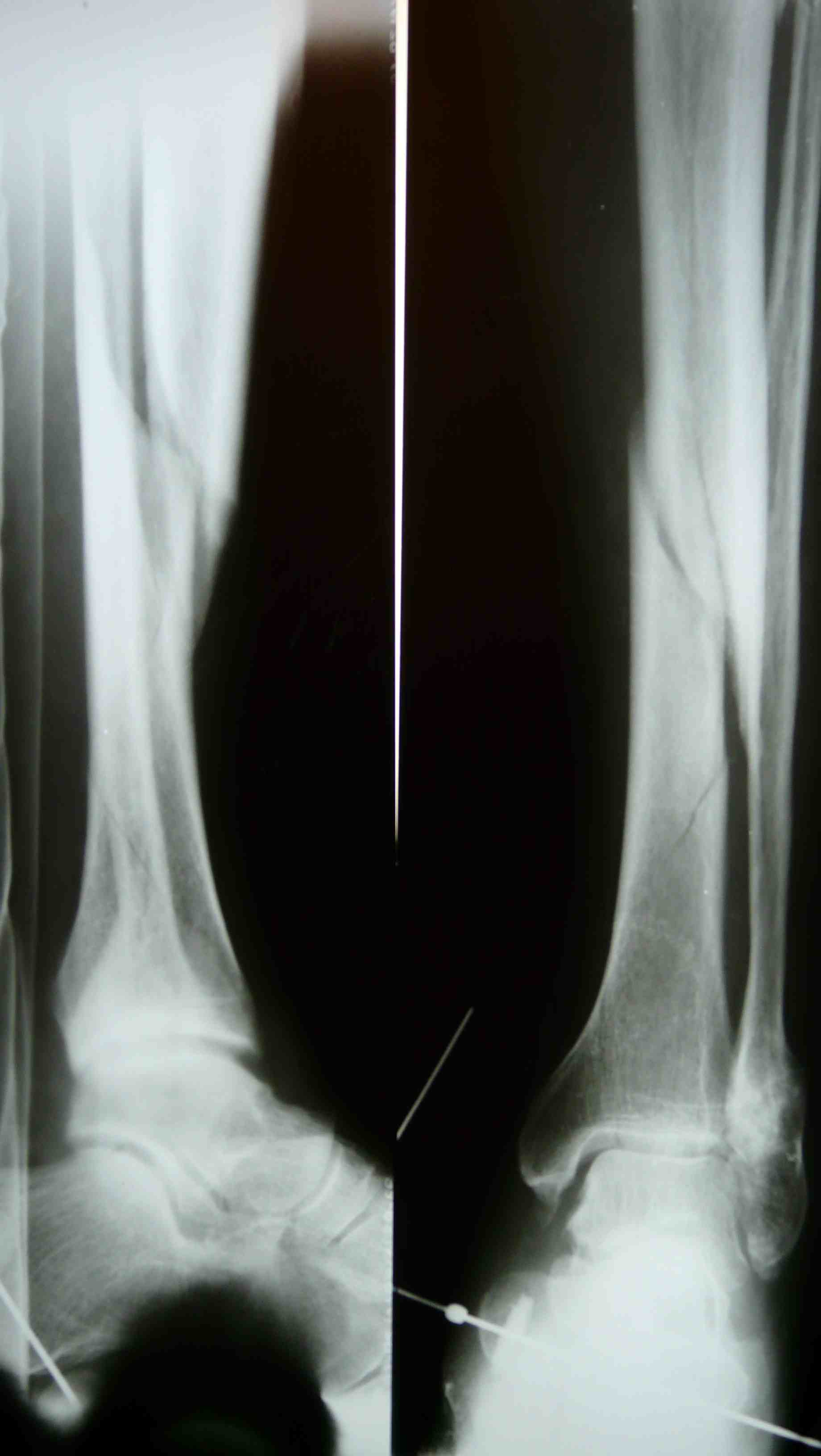 Винтообразный перелом голени рентген